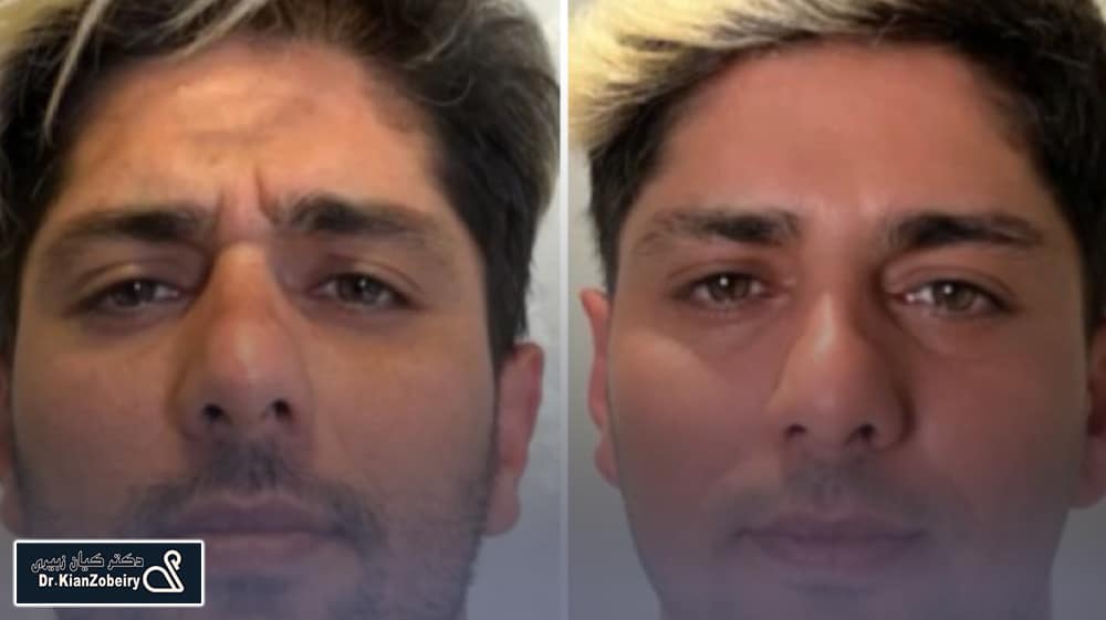 بوتاکس دیسپورت اصل و تقلبی