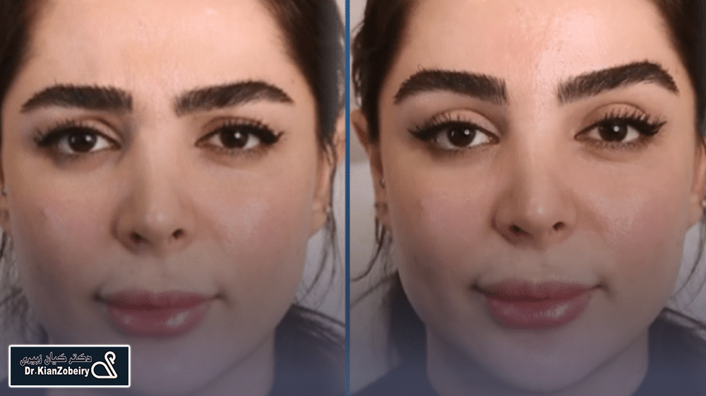 کاربردهای تزریق بوتاکس مصپورت